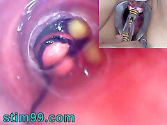 Mature Woman, Peehole Endoscope Camera in Bladder with Ballsack