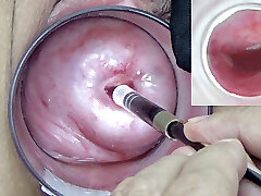 A endoscope japanese camera is inserted in the cervix to see inside the uterus.