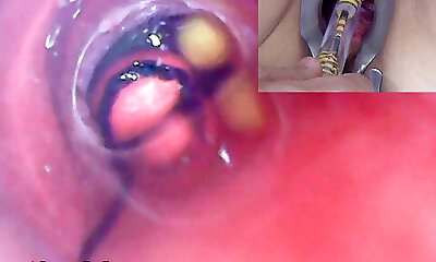 Mature Woman, Peehole Endoscope Camera in Bladder with Balls