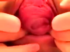 Vaginal-Und Anal-Prolaps Auf Webcam -