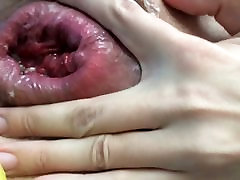 Pushing hd anal gyno videos out with Prolapse