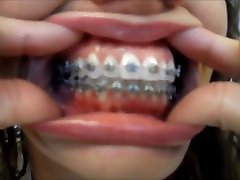 Braces Mouth exam and tour