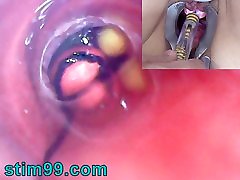 Mature Woman, Peehole Endoscope bangladeshi villages 2011 in Bladder with Balls