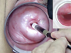 A endoscope japanese camera is inserted in the cervix to see inside the uterus.