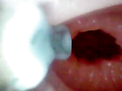 A detailed examination of Lopuza93 oral cavity and anal area using an endoscope camera.